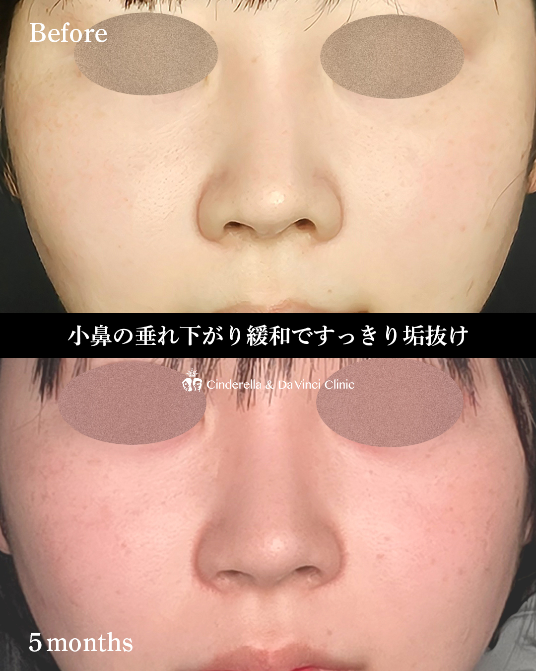 鼻孔縁挙上のみの画像