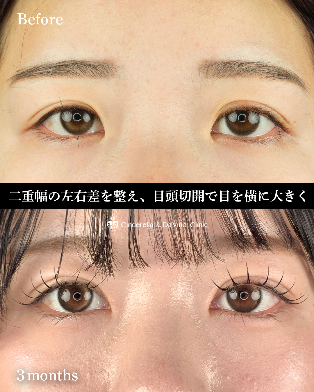 自然癒着法×目頭の画像