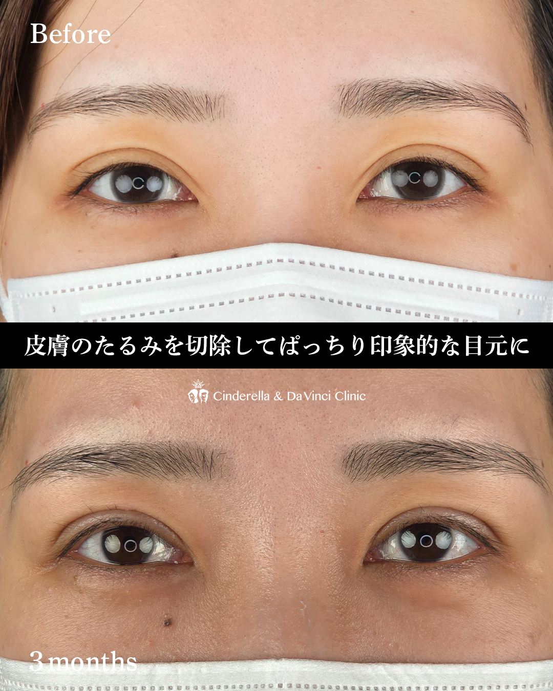 埋没から二重切開への画像