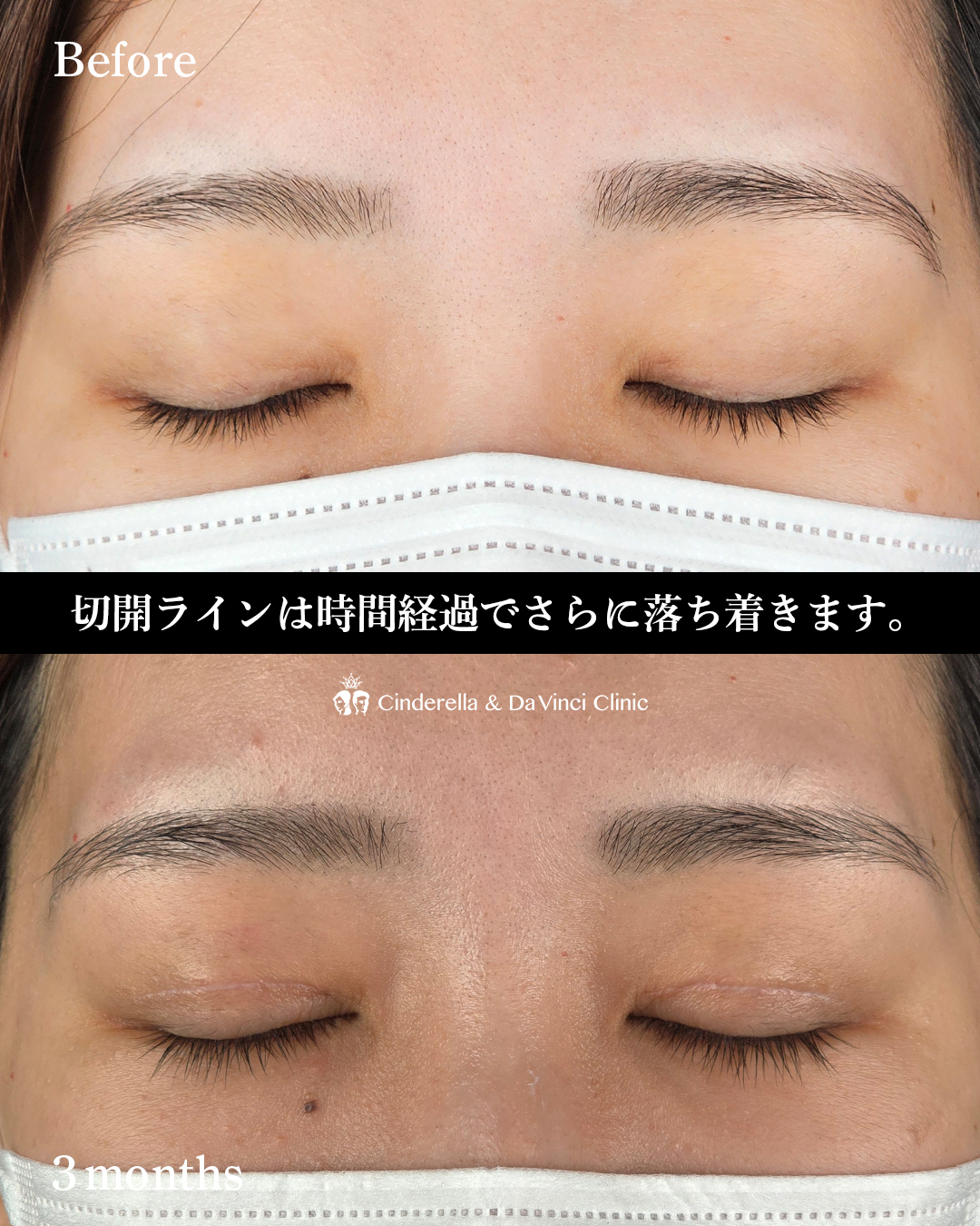 埋没から二重切開への画像