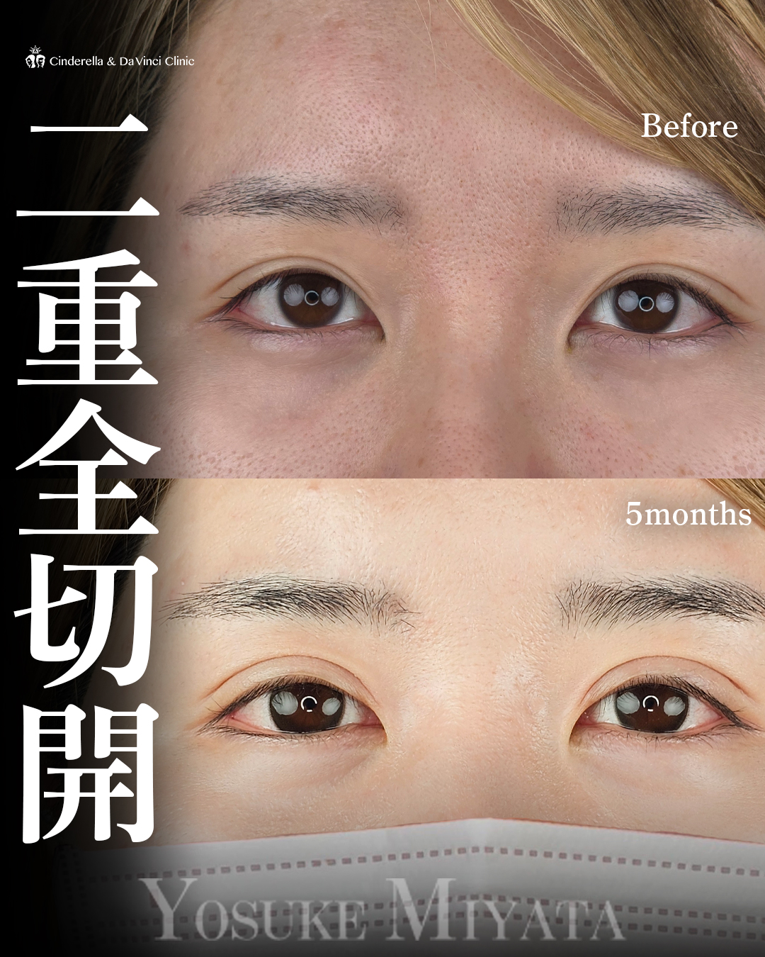 二重切開で平行二重の画像