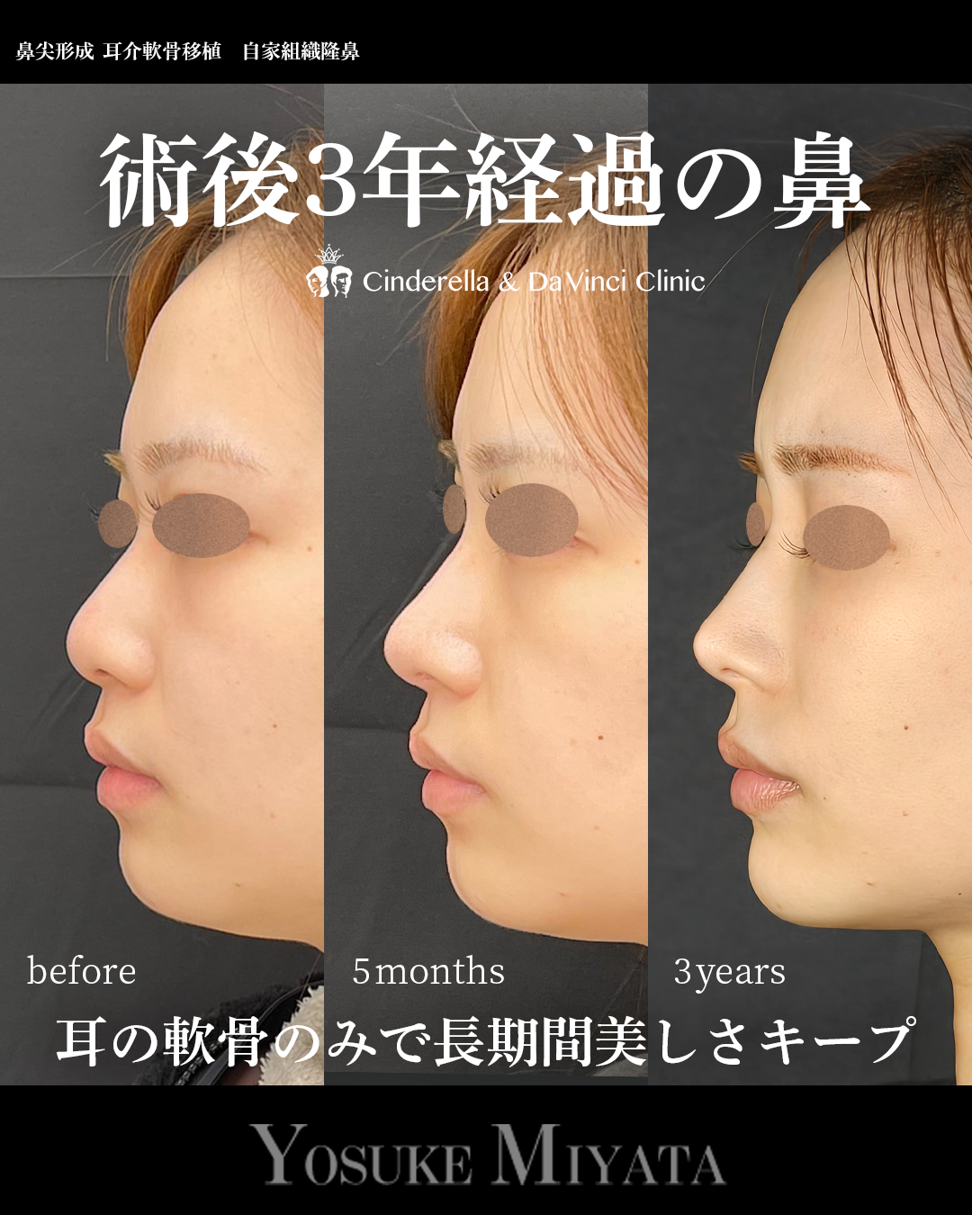 鼻整形で3年経過