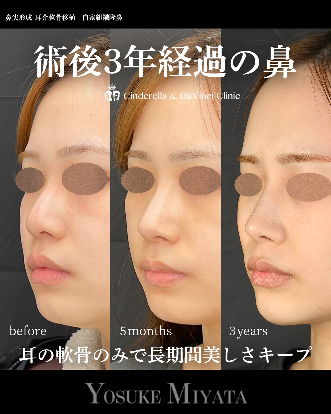 鼻整形で3年経過の画像