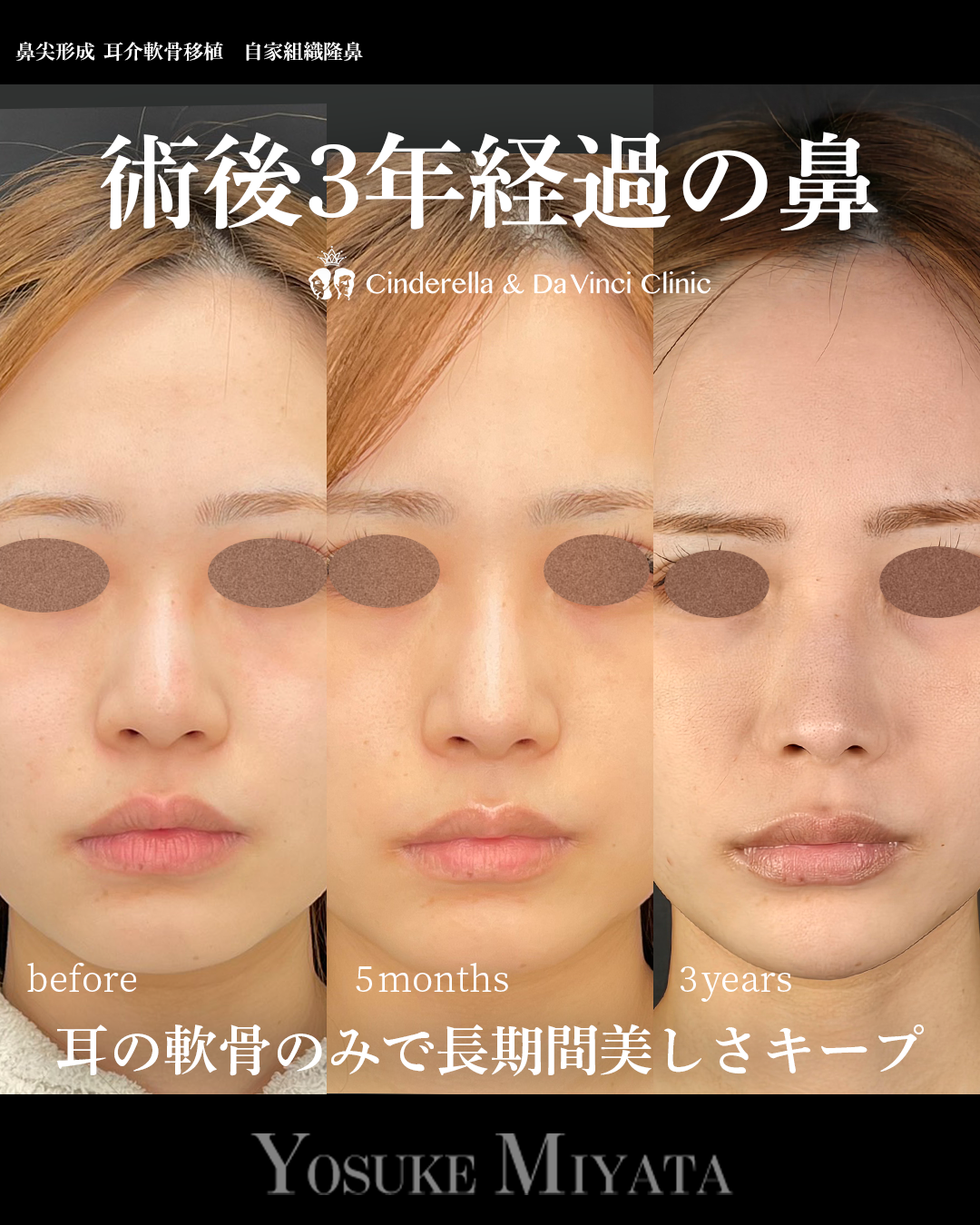 鼻整形で3年経過の画像