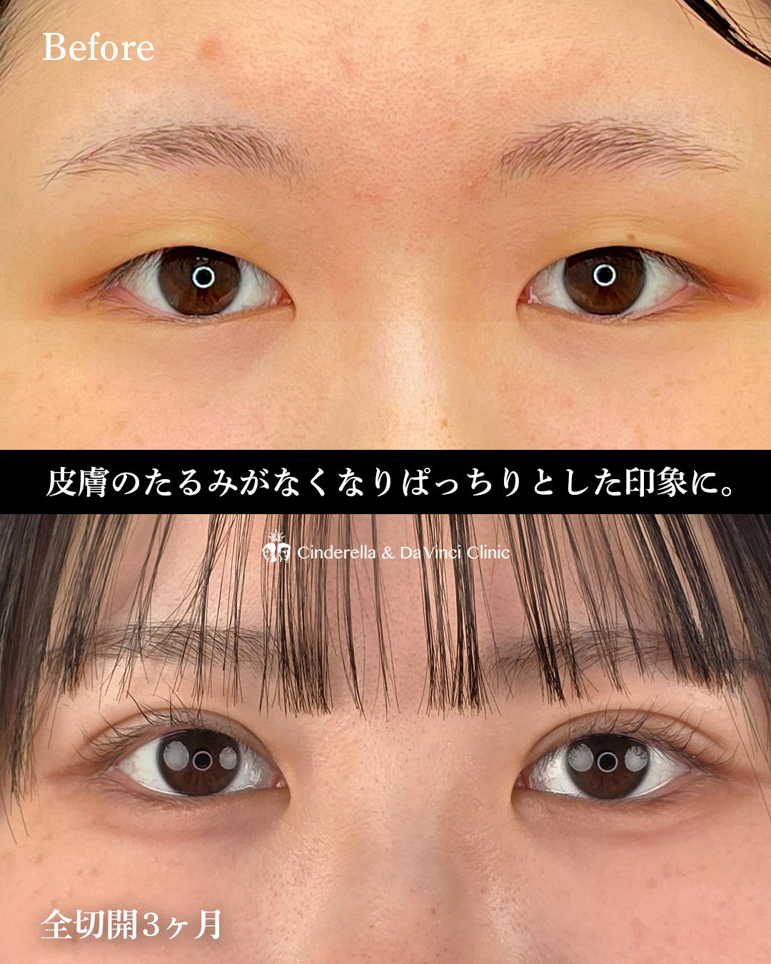 自然癒着後の全切開の画像