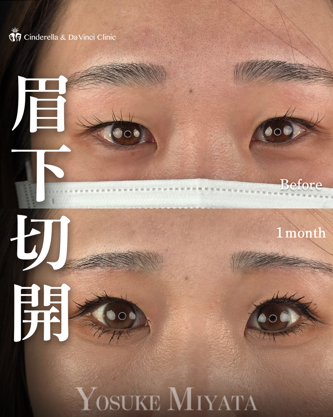 眉下切開でたるみ切除