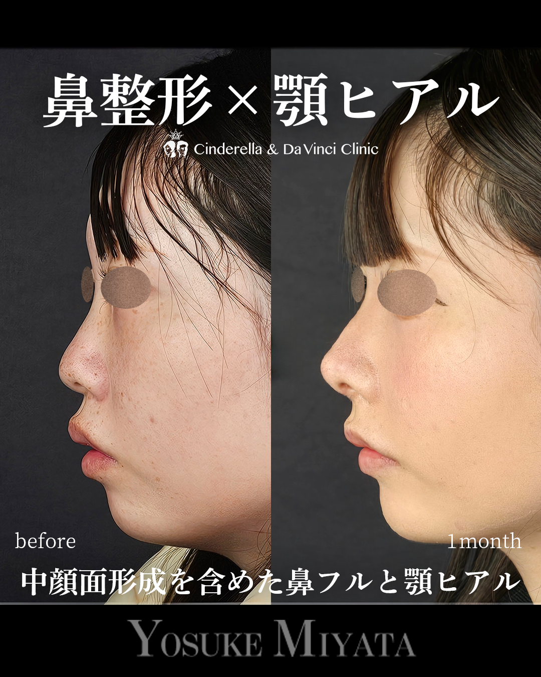 鼻整形と顎ヒアル