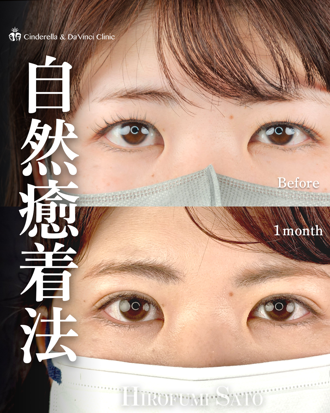 自然癒着法で自然な二重