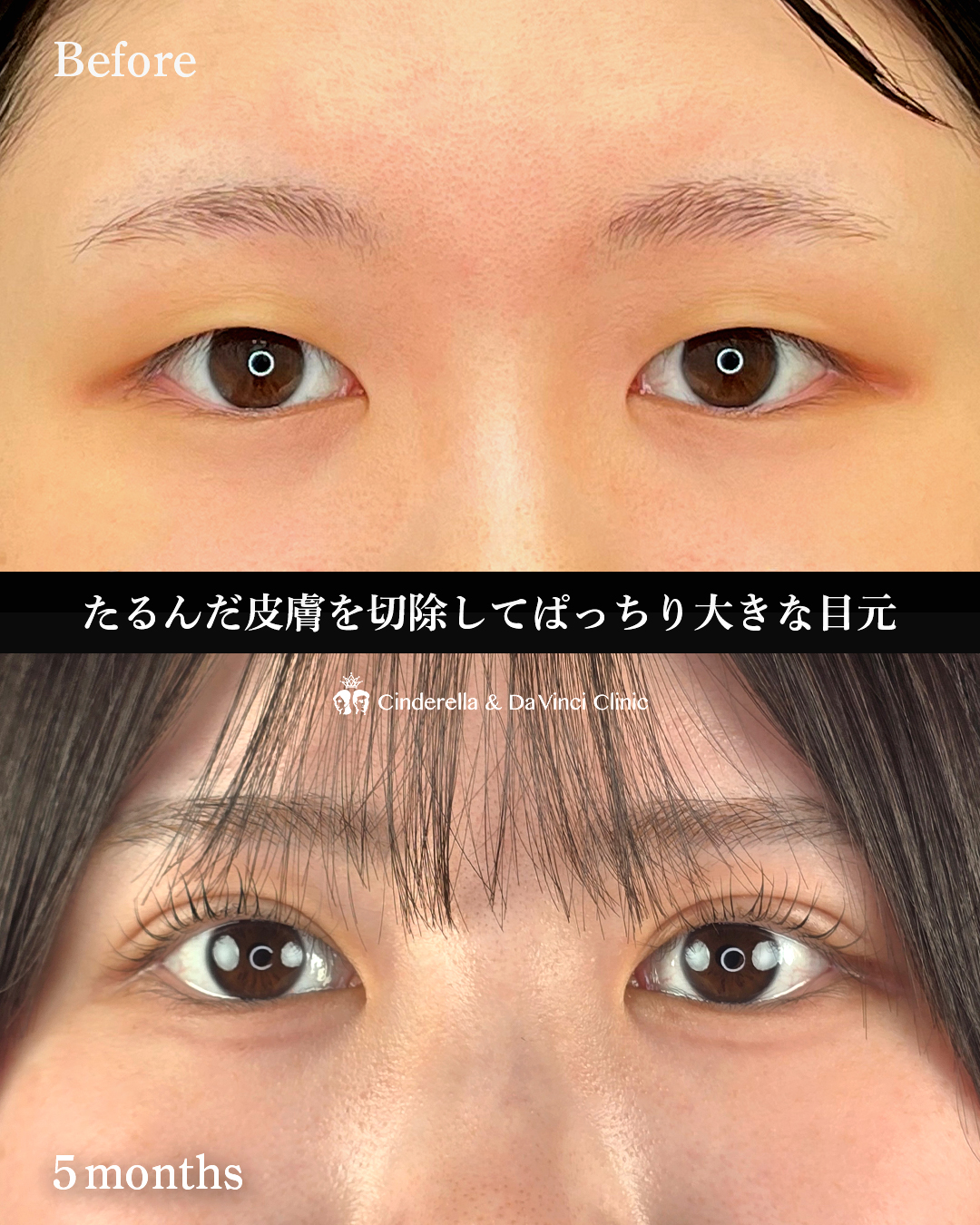 自然癒着後の全切開の画像