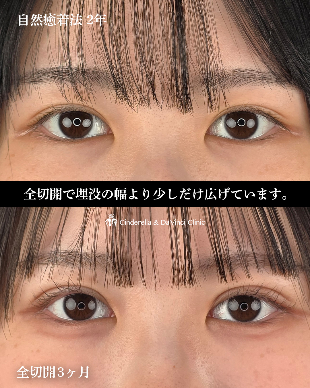 自然癒着後の全切開の画像