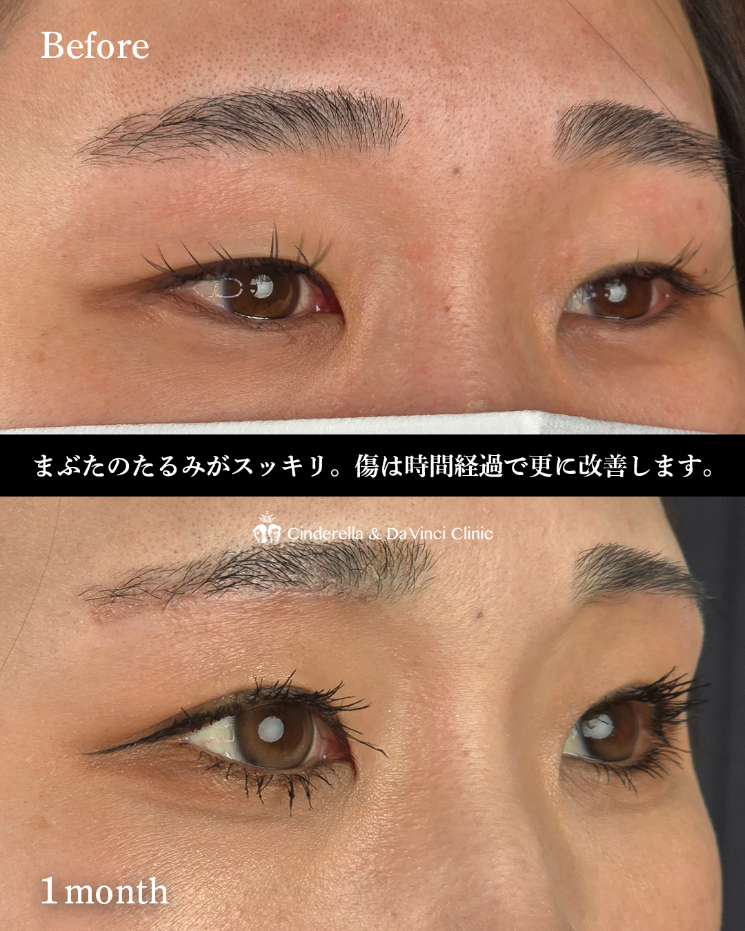 眉下切開でたるみ切除の画像