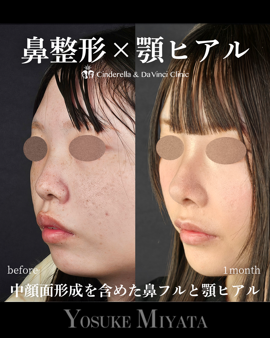 鼻整形と顎ヒアルの画像