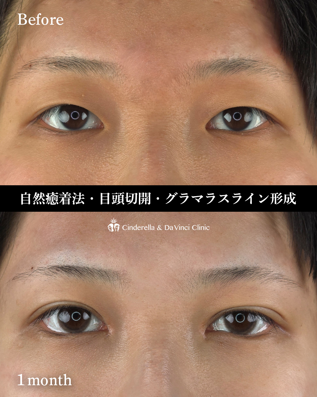 目元フル施術の画像