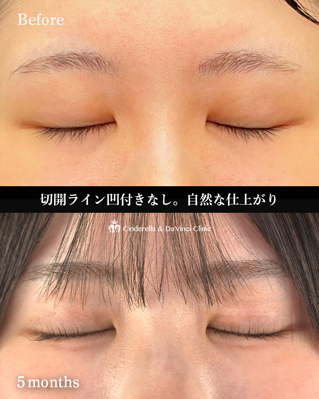 自然癒着後の全切開の画像
