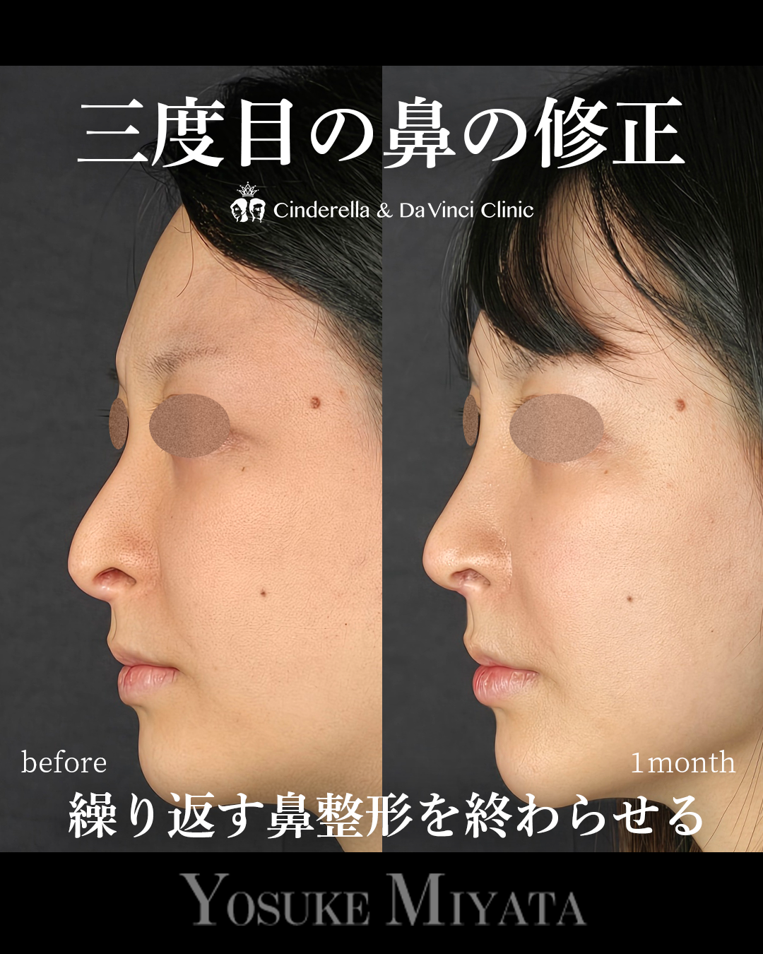 3回目の鼻整形修正