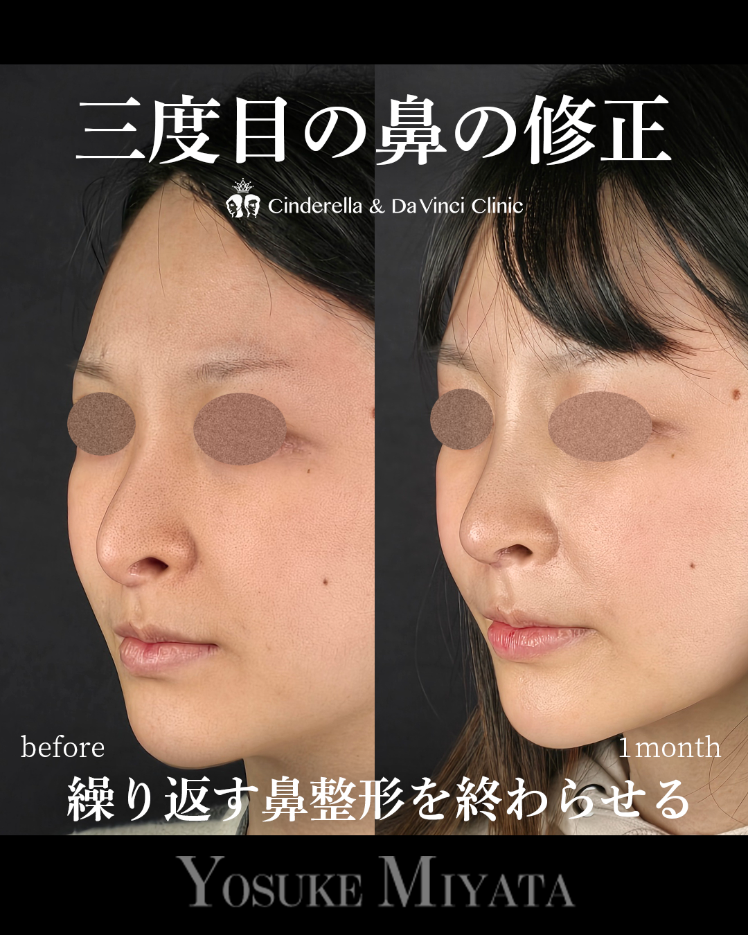 3回目の鼻整形修正の画像