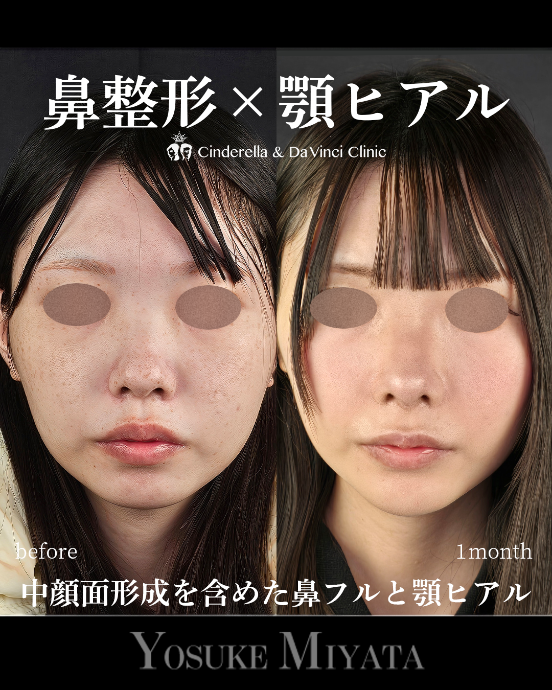 鼻整形と顎ヒアルの画像