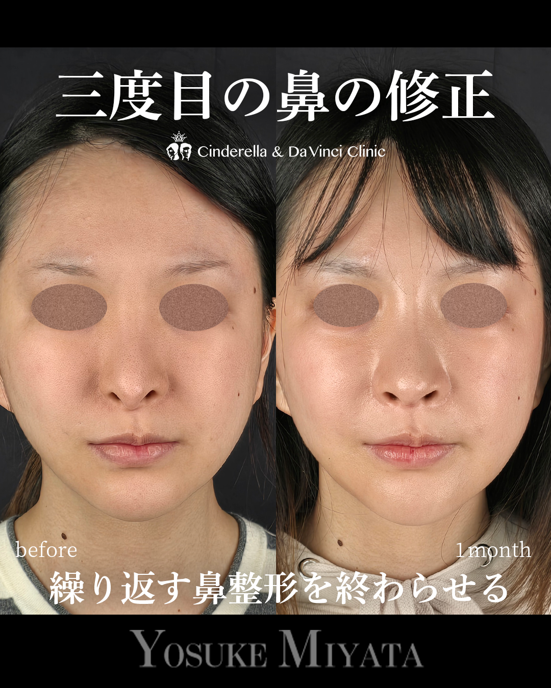 3回目の鼻整形修正の画像