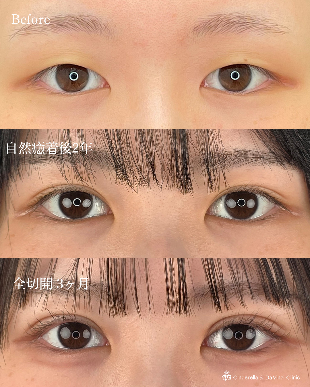 自然癒着後の全切開の画像