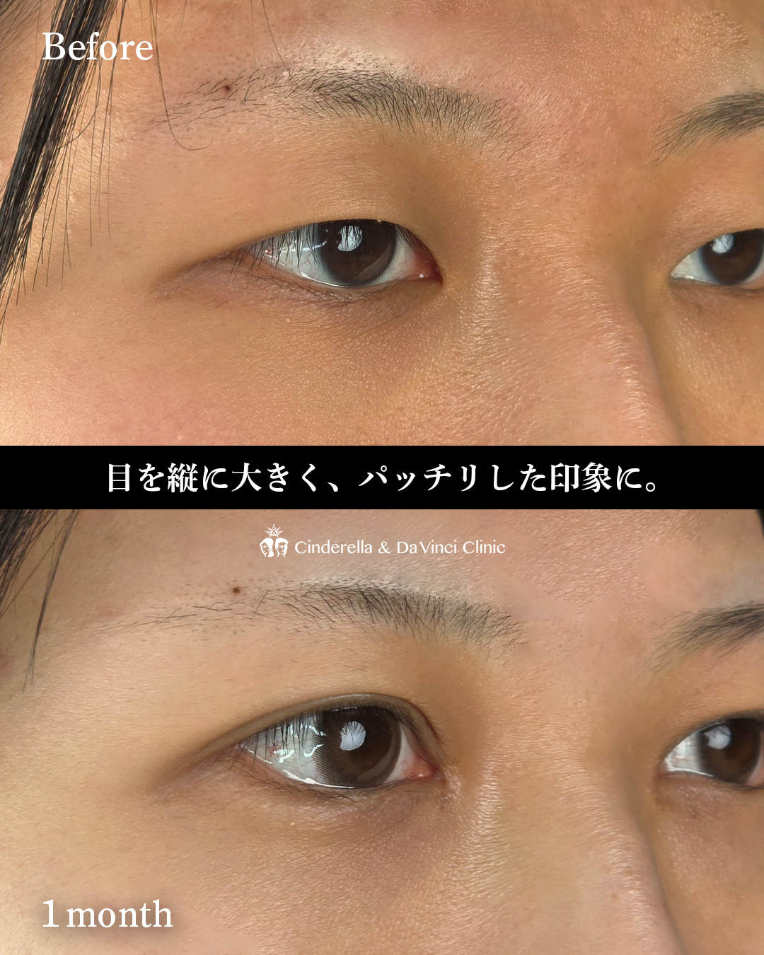 目元フル施術の画像