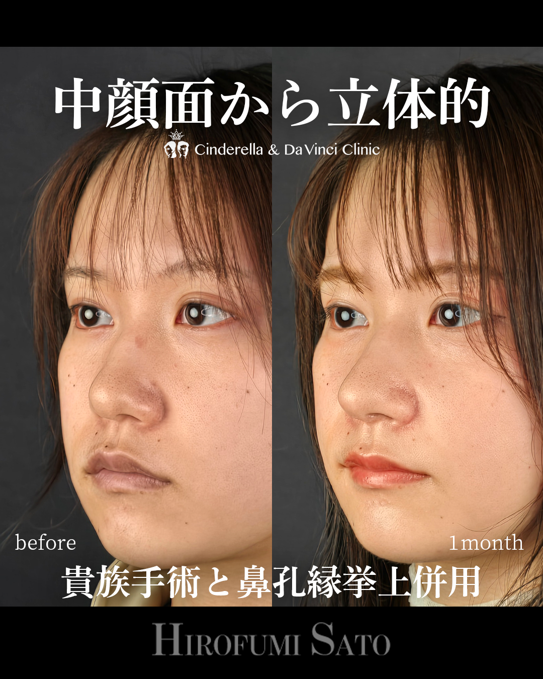 ナチュラルな忘れ鼻の画像