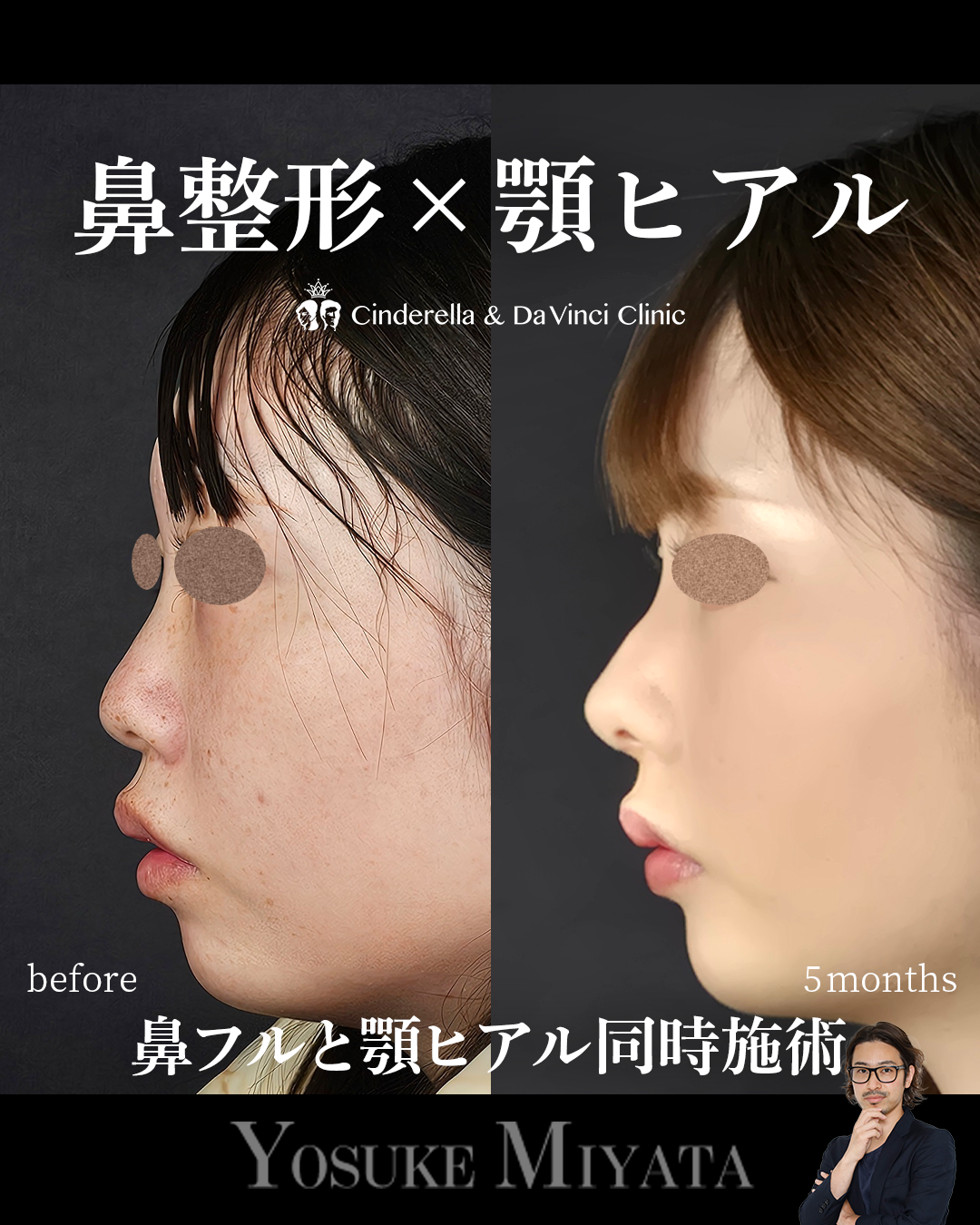 鼻整形と顎ヒアルの画像
