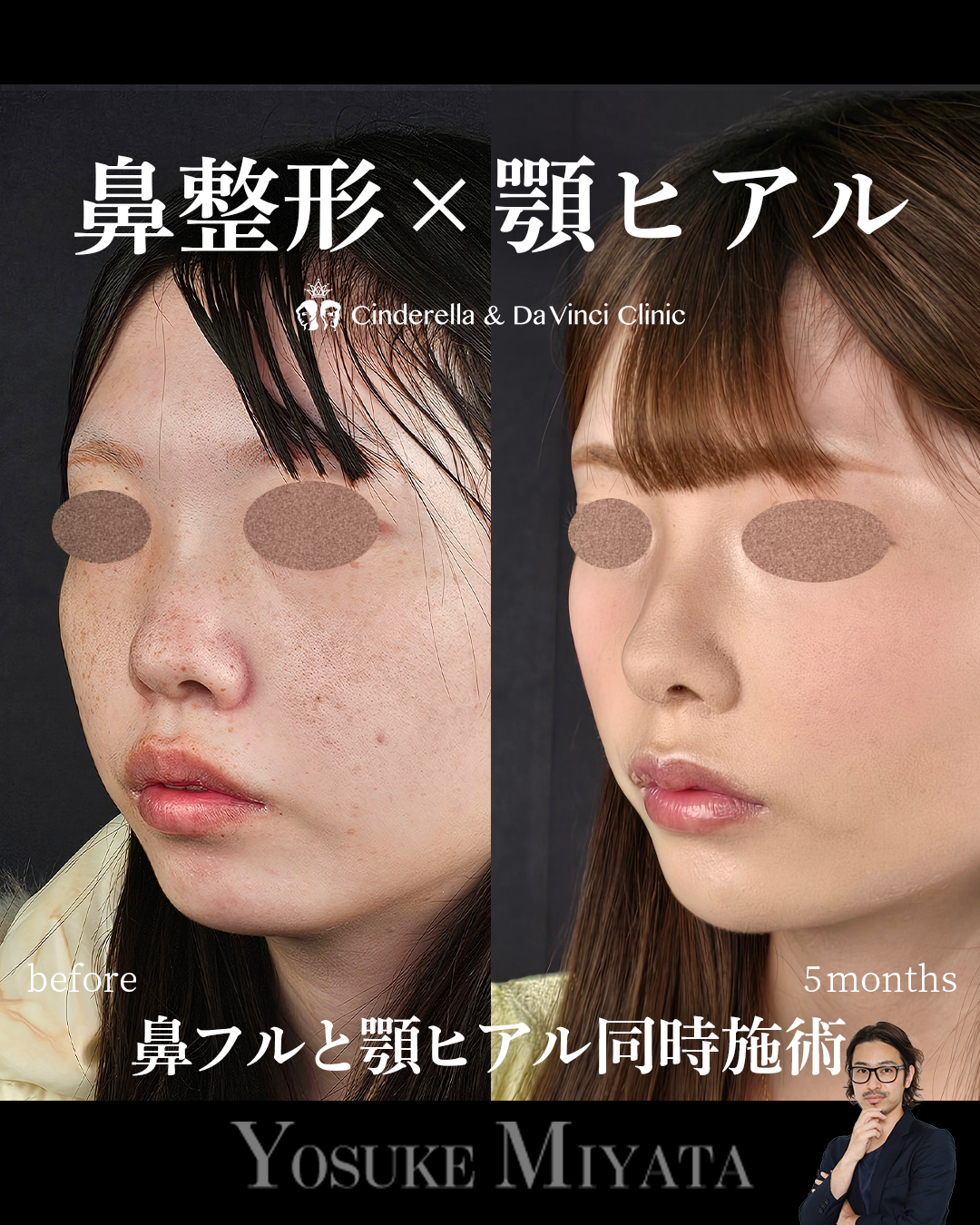 鼻整形と顎ヒアルの画像