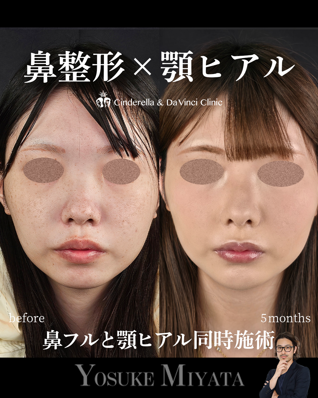 鼻整形と顎ヒアルの画像