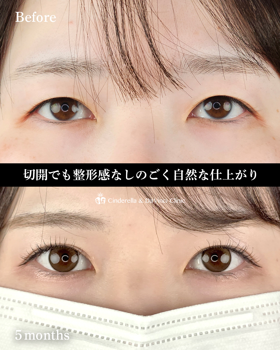 切開でナチュラルな二重の画像
