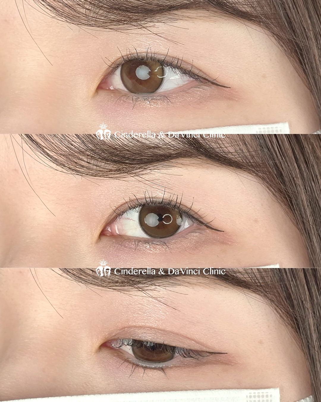 切開でナチュラルな二重の画像