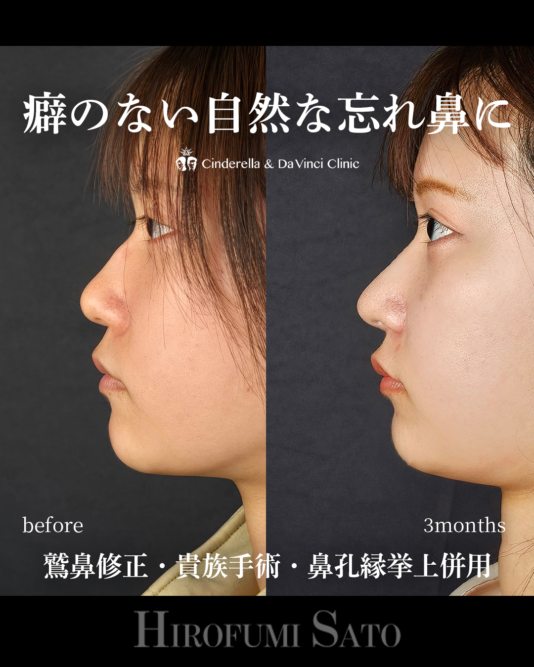 ナチュラルな忘れ鼻の画像