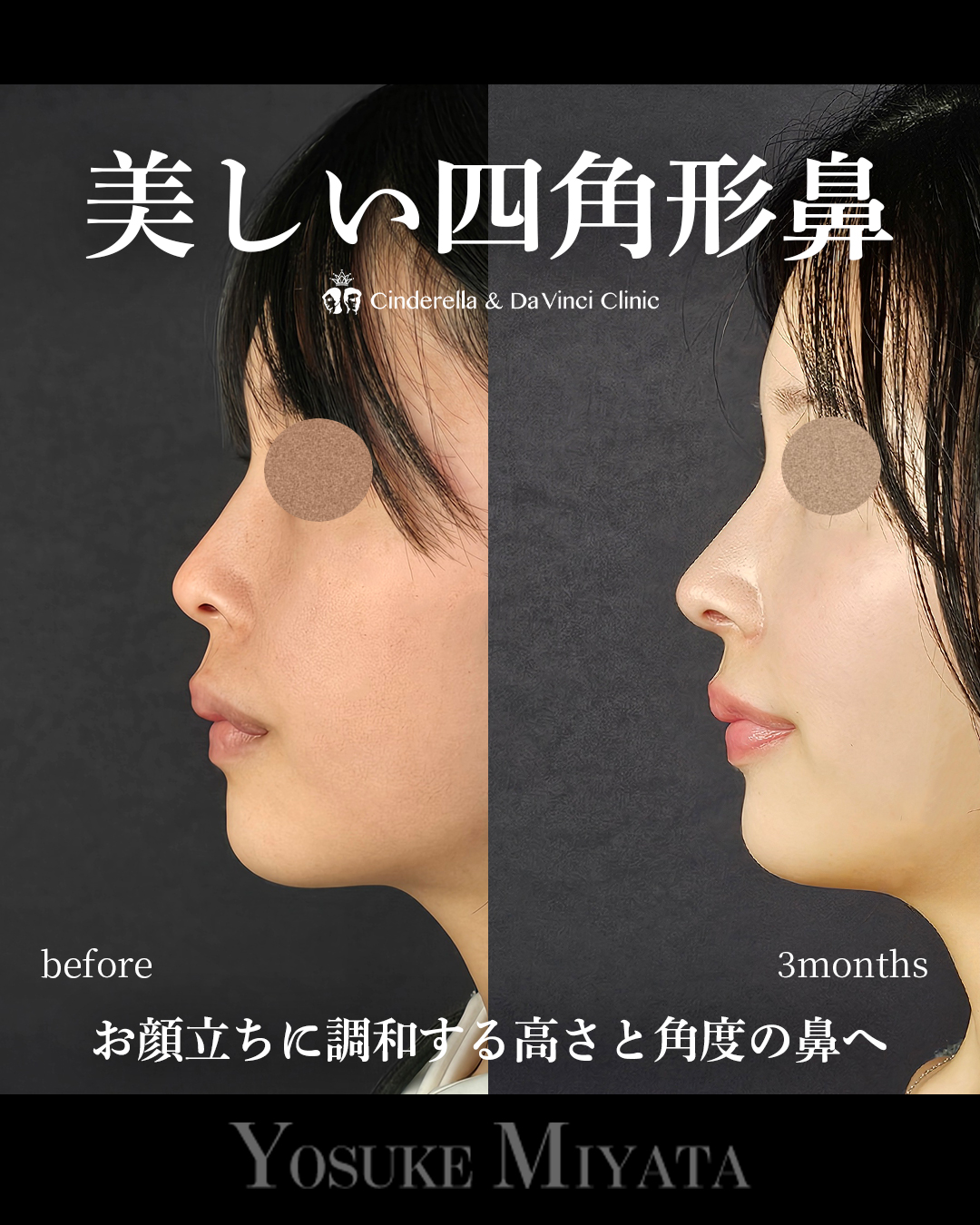 綺麗な四角形鼻の画像