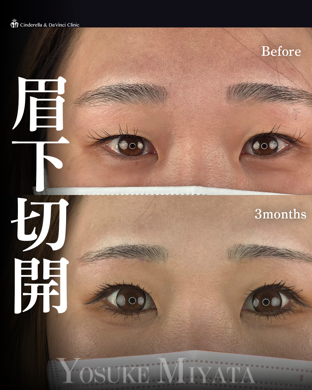 眉下切開でたるみ切除の画像