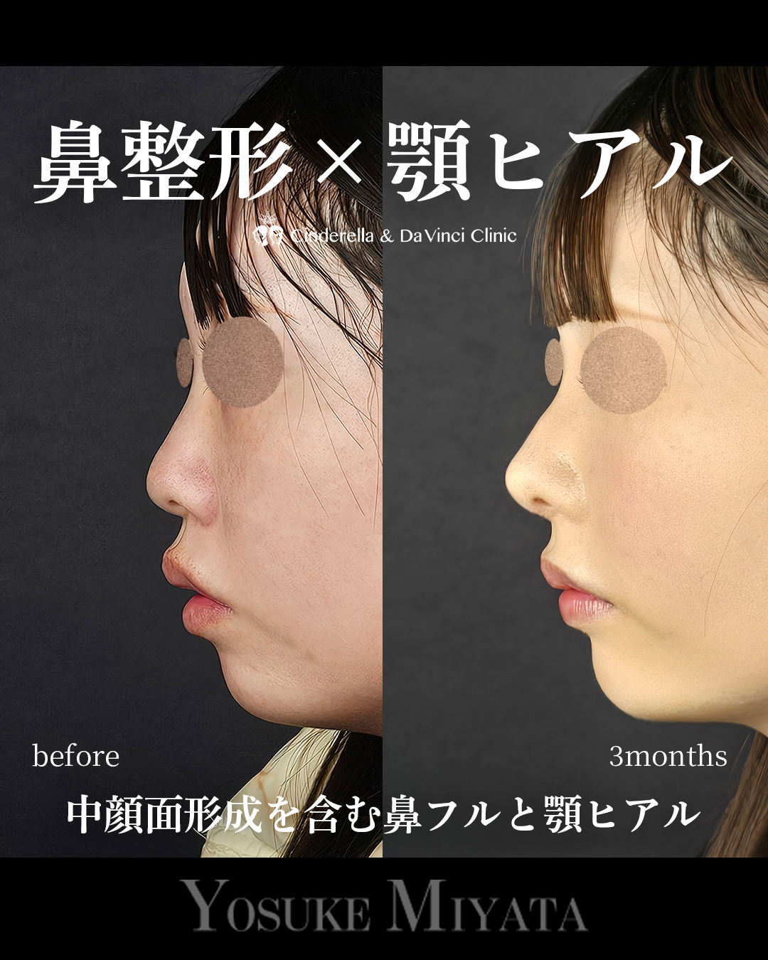 鼻整形と顎ヒアルの画像