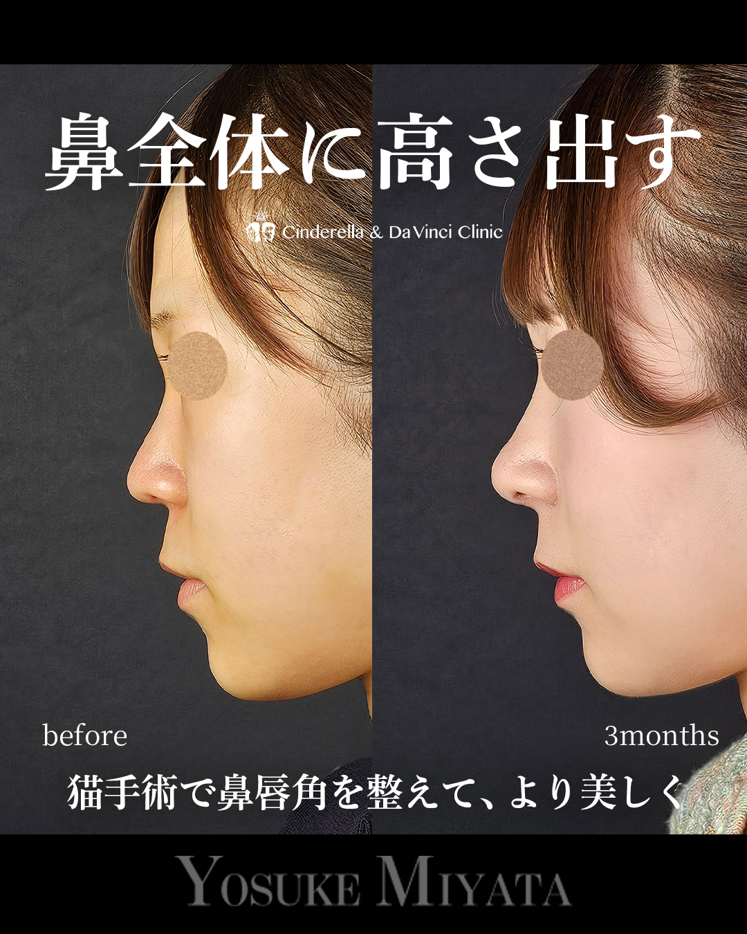 鼻全体の高さを出すの画像