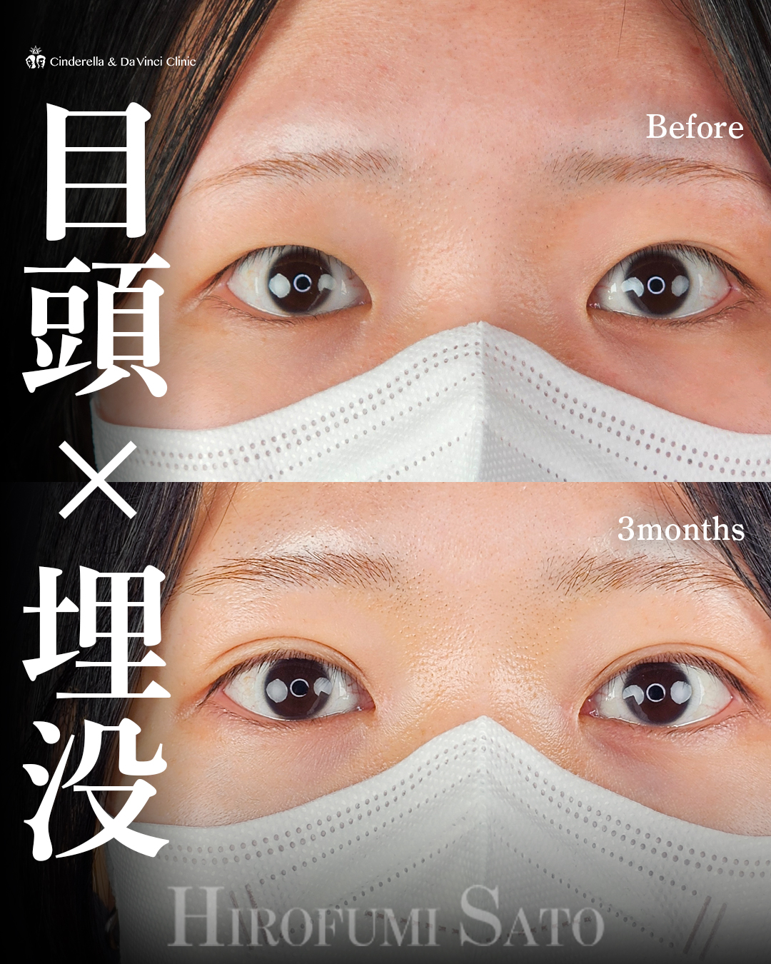 目頭切開と埋没の画像