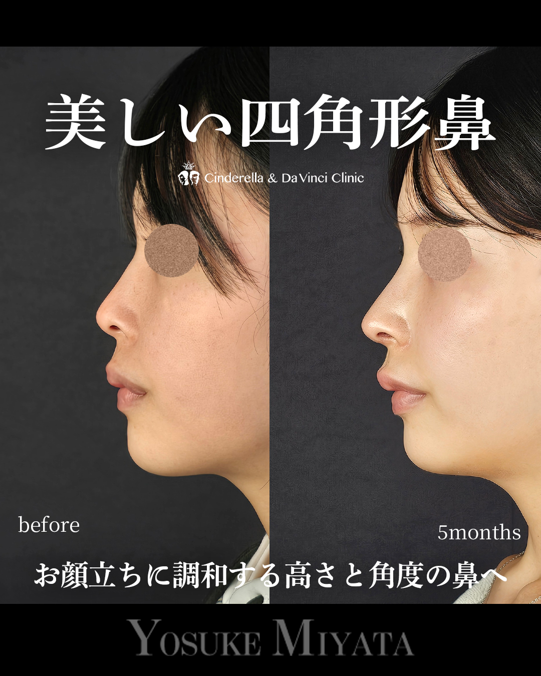 綺麗な四角形鼻の画像