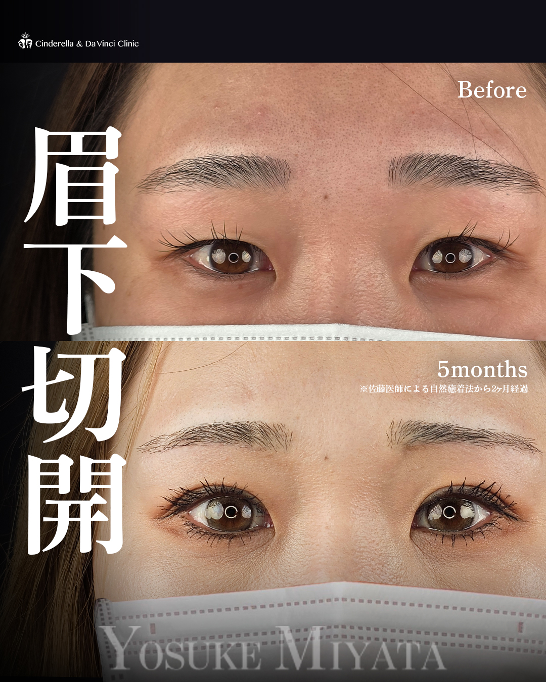 眉下切開でたるみ切除の画像