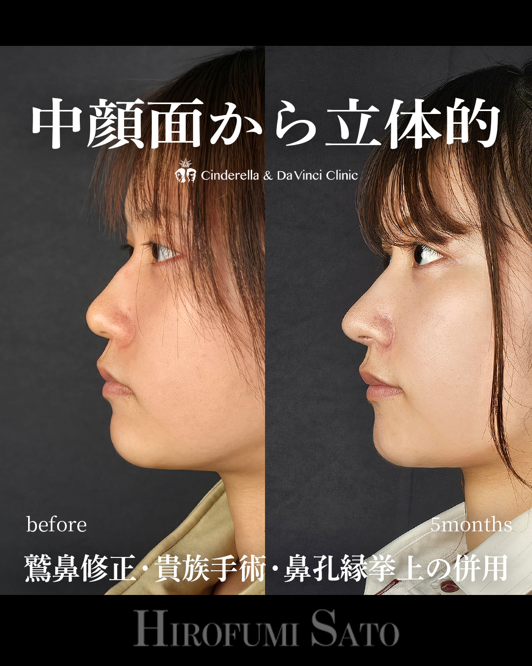 ナチュラルな忘れ鼻の画像