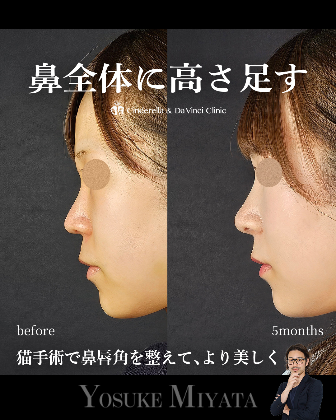 鼻全体の高さを出すの画像