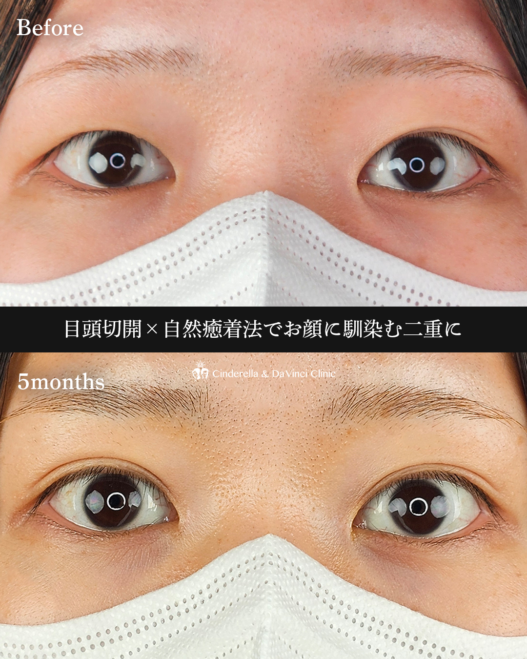 目頭切開と埋没の画像