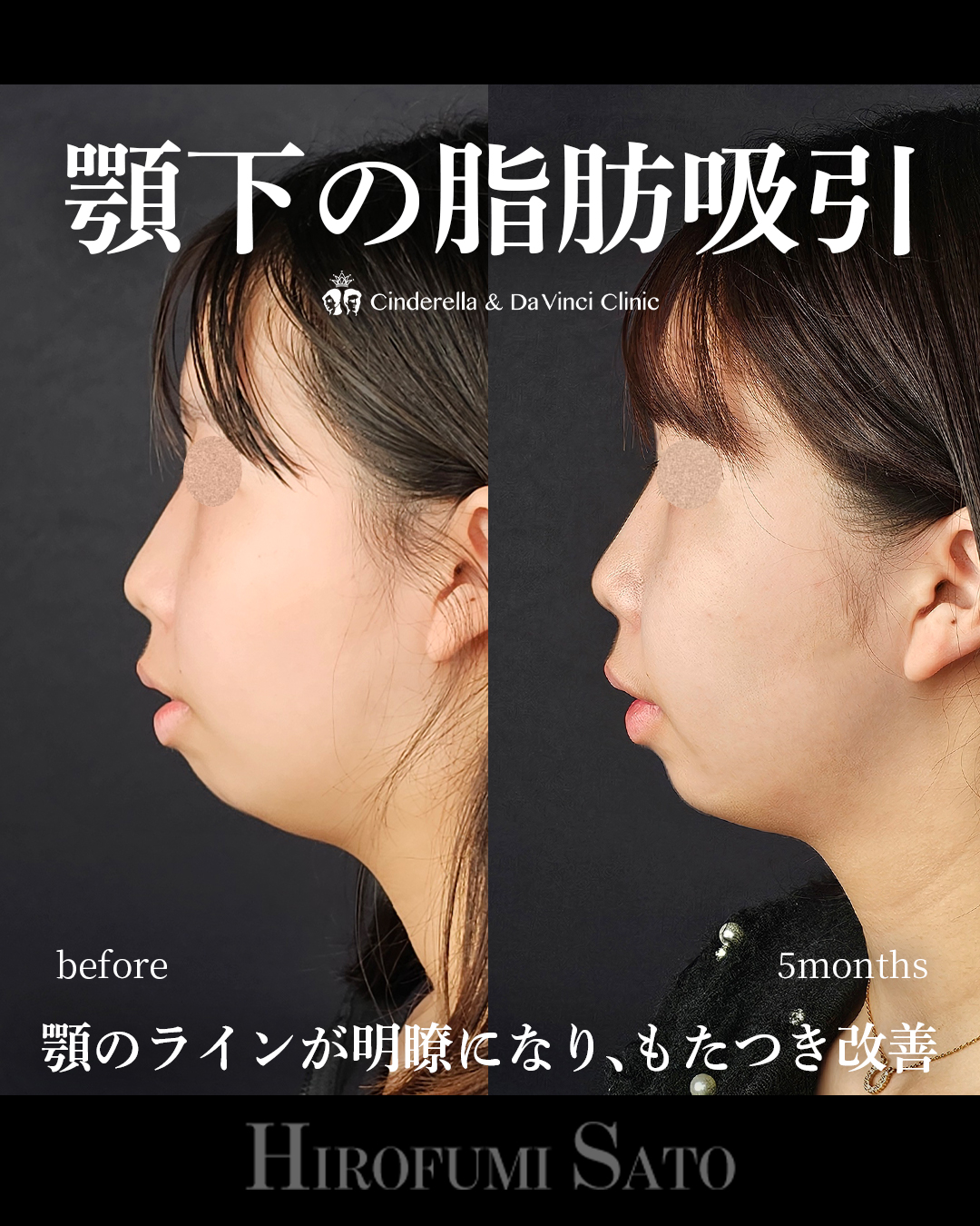 顎下の脂肪吸引