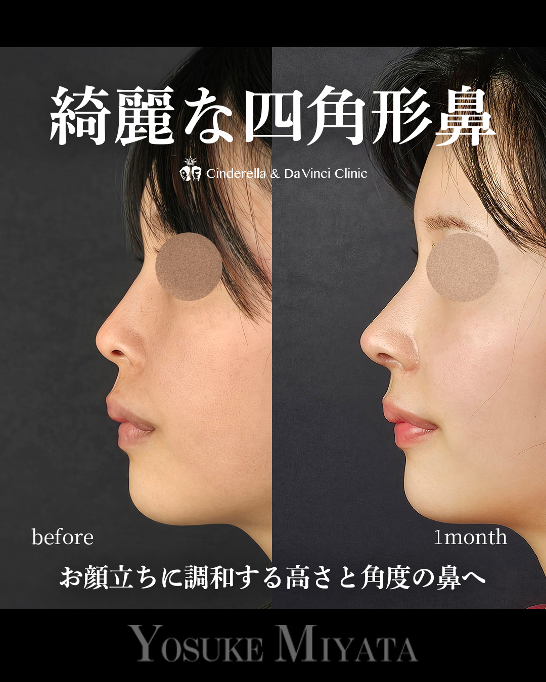 綺麗な四角形鼻