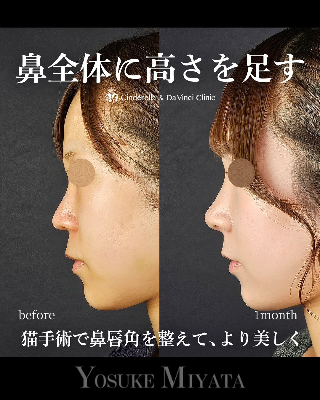 鼻全体の高さを出す