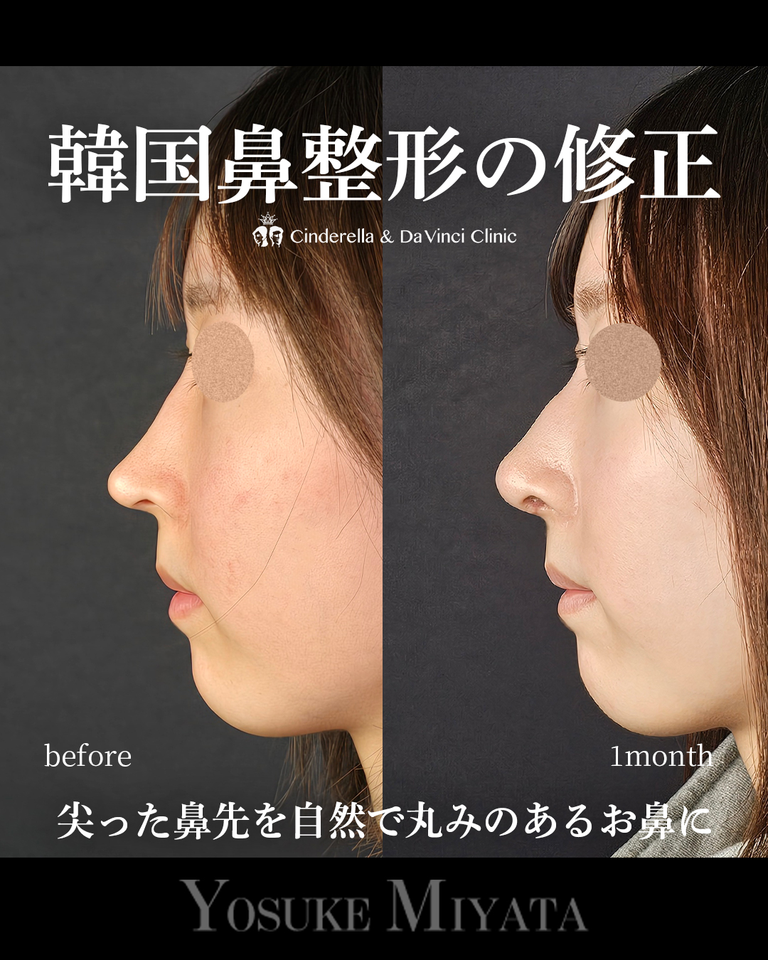韓国鼻整形の修正