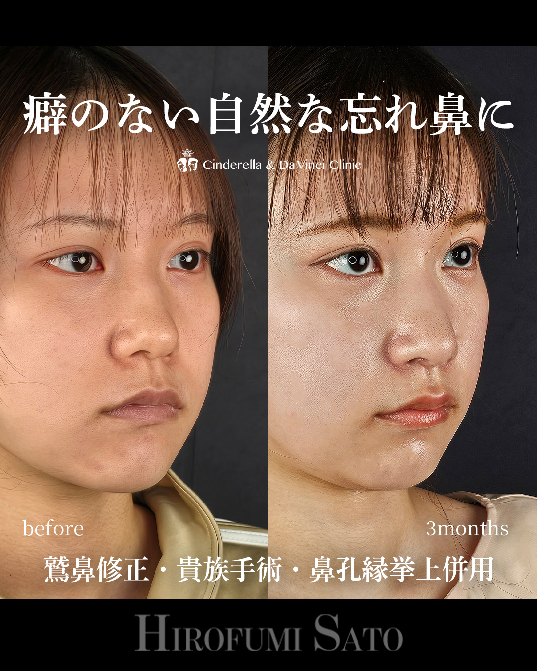 ナチュラルな忘れ鼻の画像