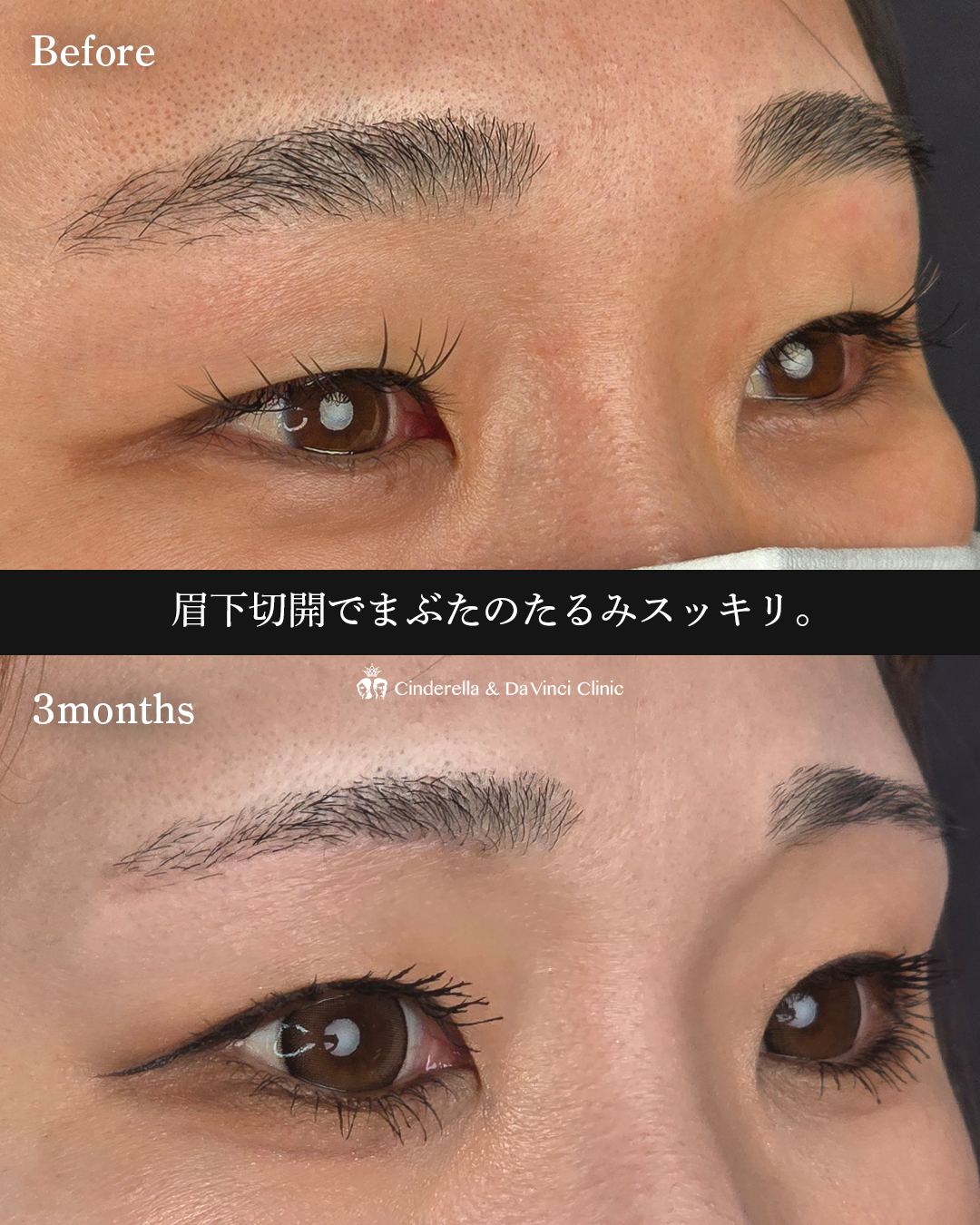 眉下切開でたるみ切除の画像