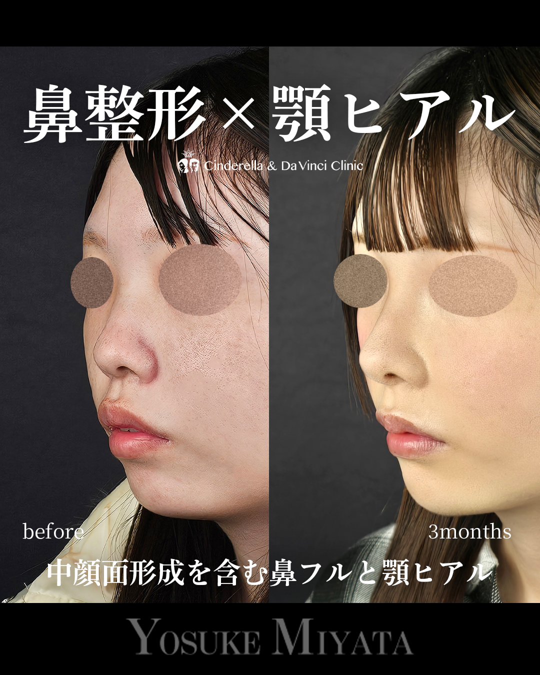 鼻整形と顎ヒアルの画像