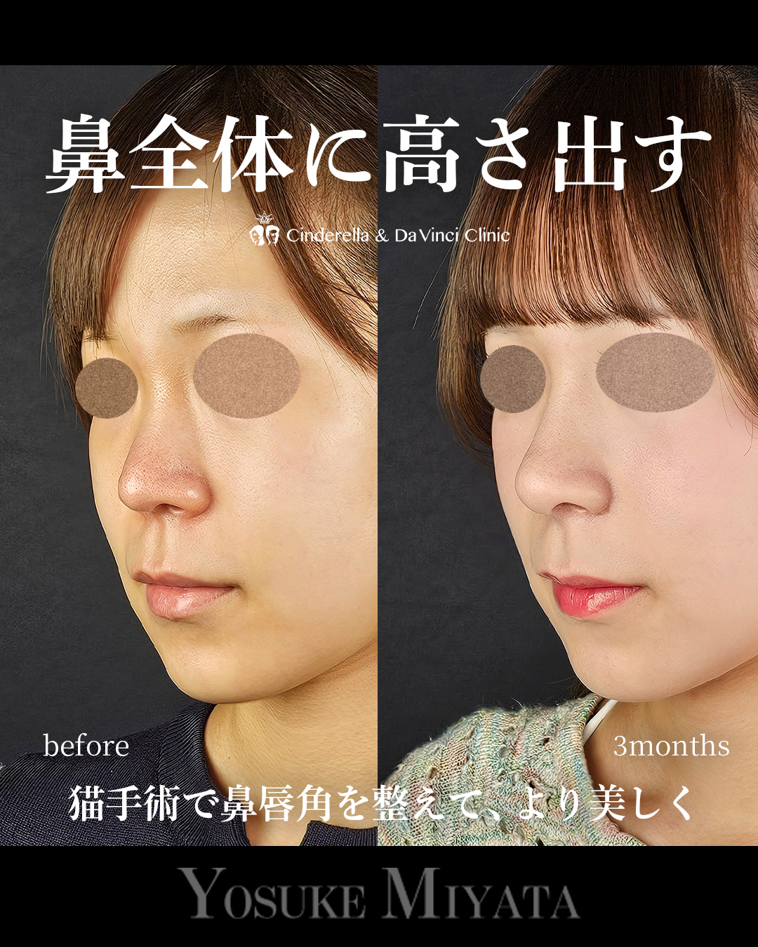 鼻全体の高さを出すの画像