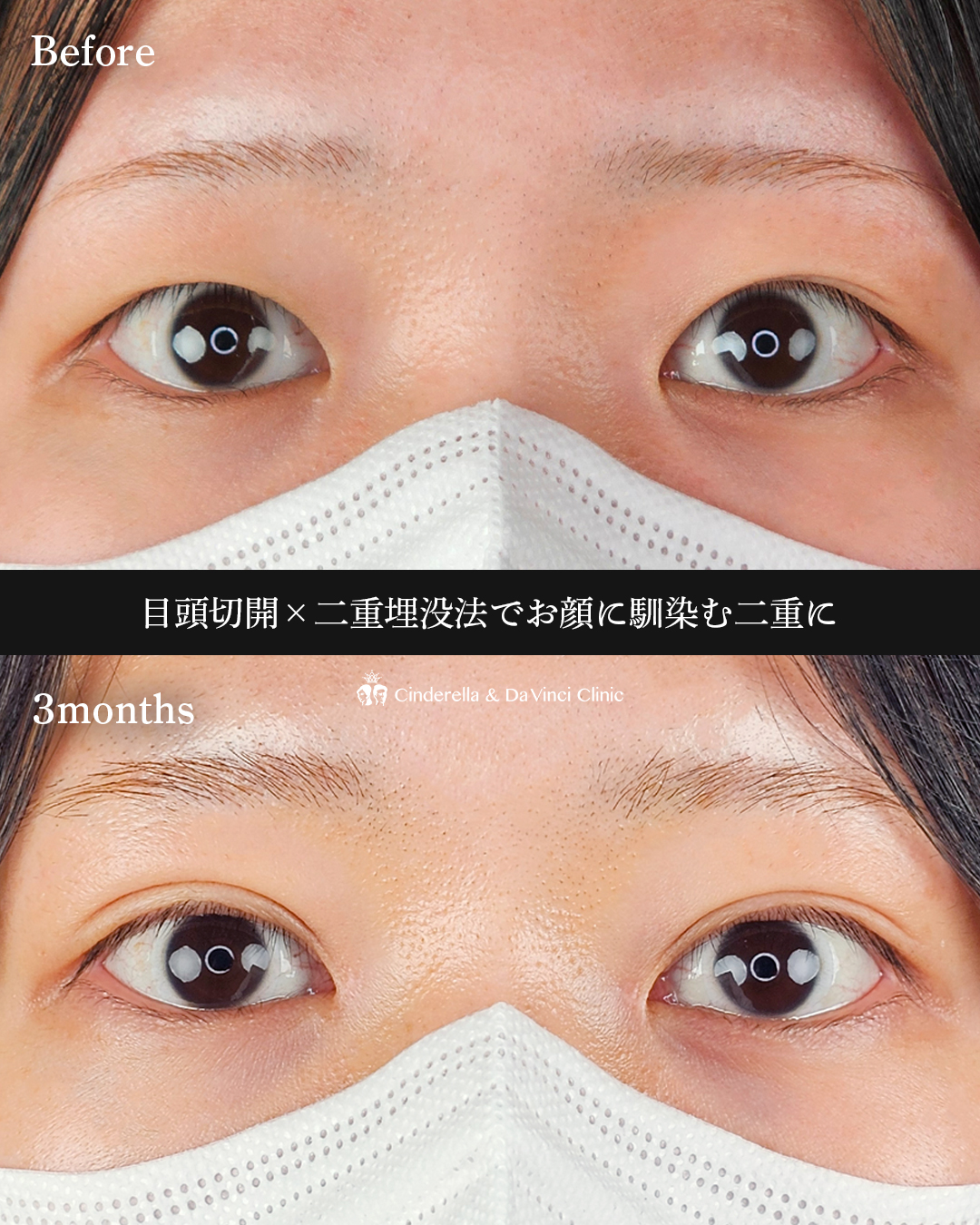 目頭切開と埋没の画像
